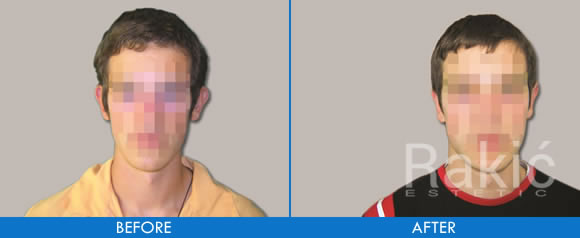 Corrective earlobe surgery